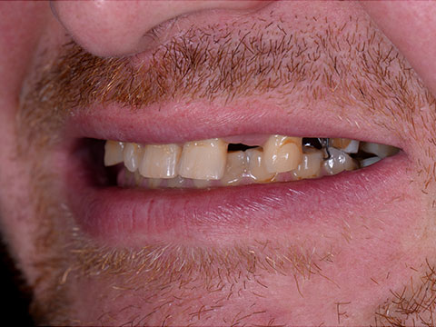 dental-Implant-before