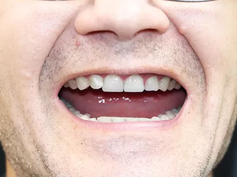 dental-Implant-after