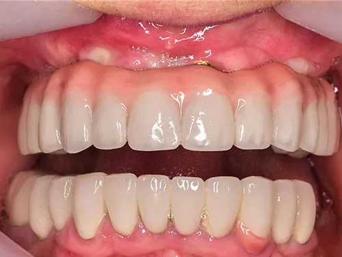 dental-Implant-before