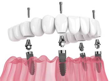 
complete 4 dental implant melbourne