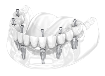 
complete dental implants costs melbourne