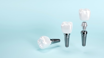 price of local teeth implant melbourne