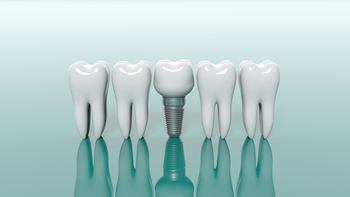 tooth implant expenses overseas melbourne